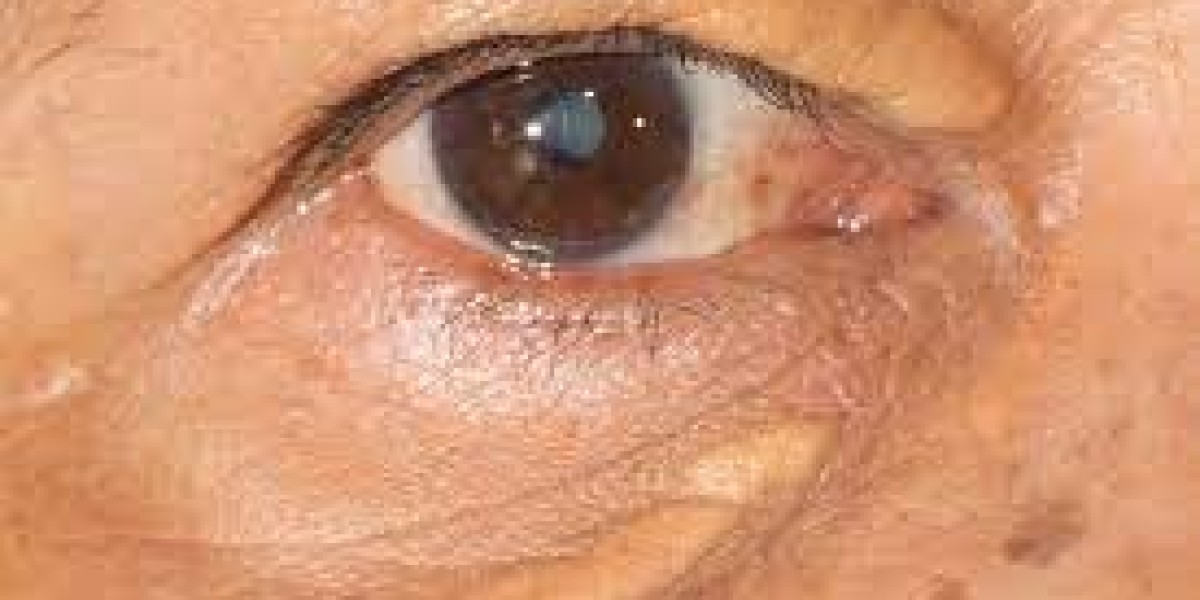 Comprehensive Guide to Eyelid Xanthelasma Removal