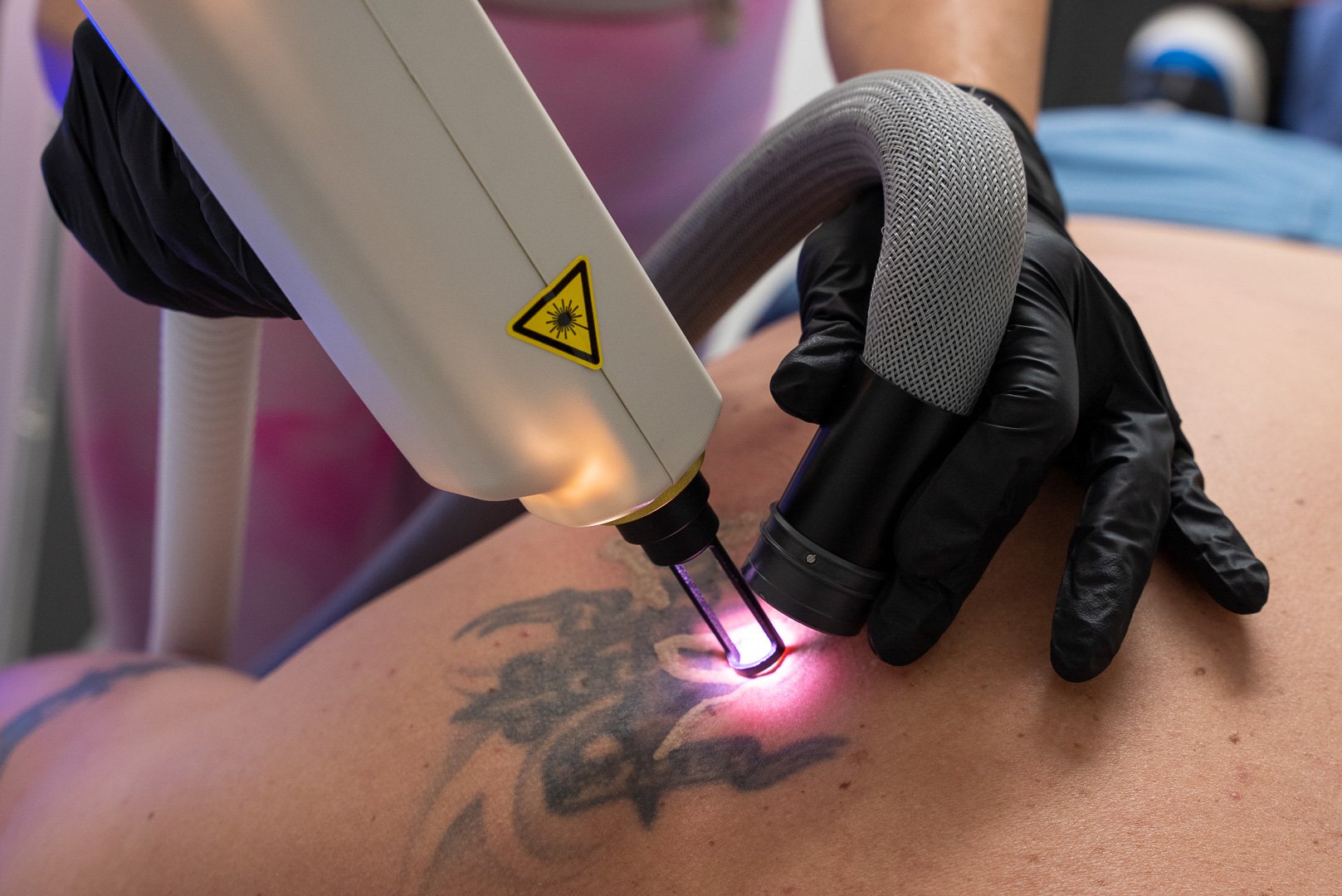 Whizolosophy | The Ultimate Guide to Laser Tattoo Removal in Dubai