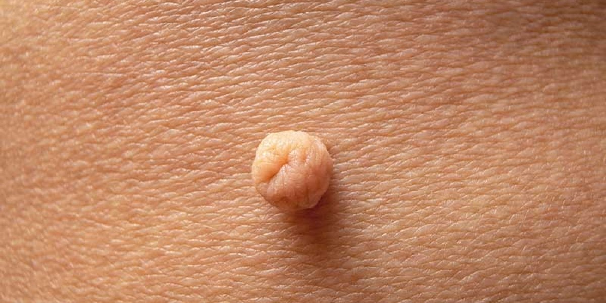 Get Rid of Skin Tags for Good with Proven Skin Tag Removal Treatment