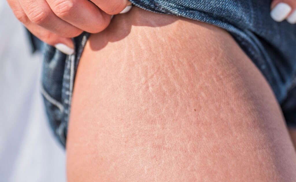 Revolutionizing Beauty: Laser Stretch Mark Removal in Dubai