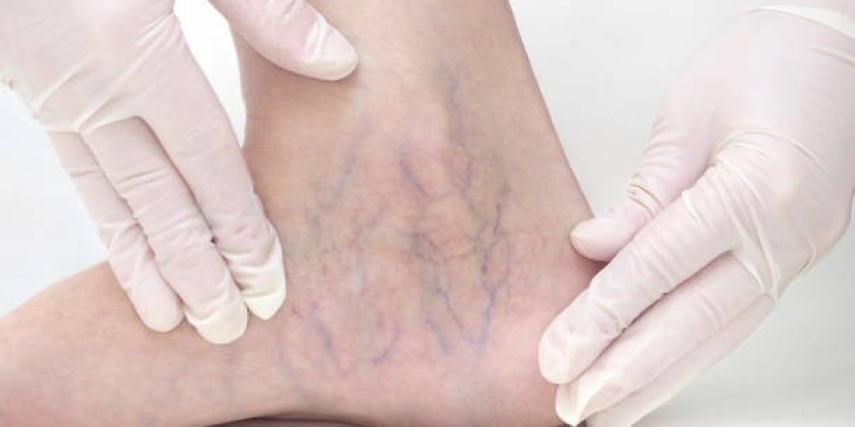 Your Guide to Varicose Veins Treatment in Riyadh