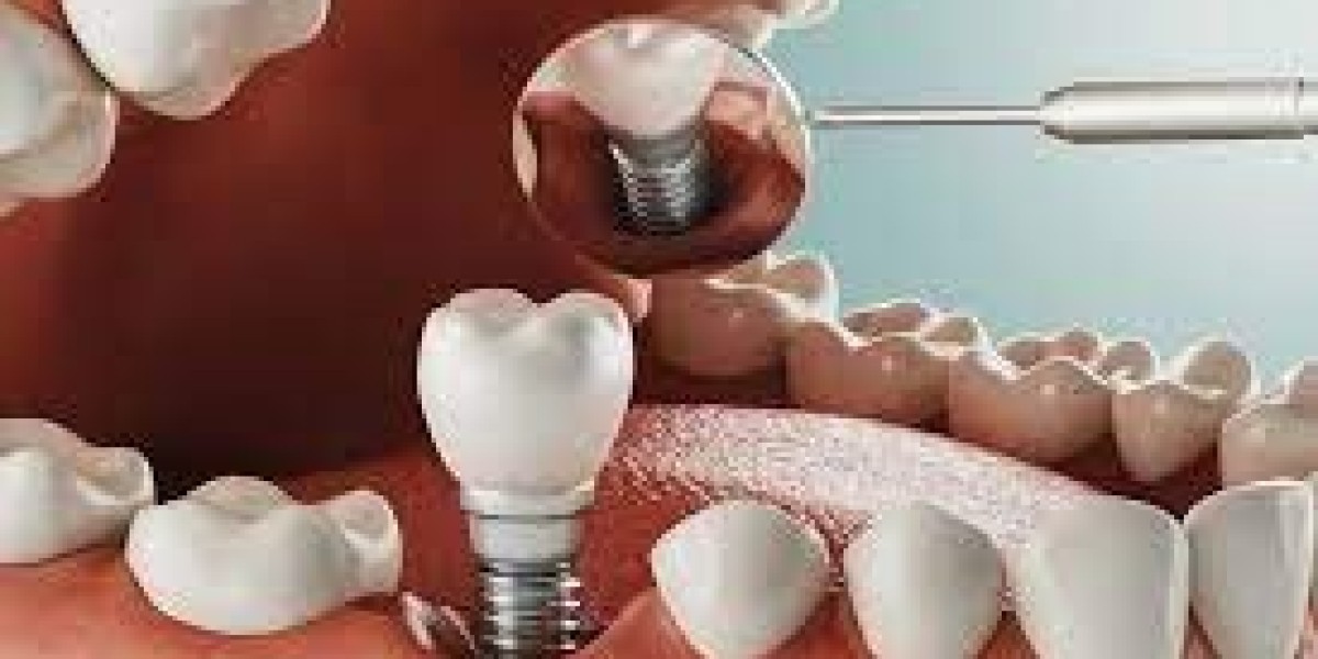 Quality vs. Cost: Finding the Best Single Tooth Implant Deal in Dubai
