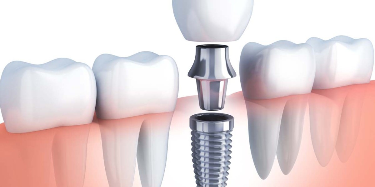 Investing in Your Smile: Dubai Implant Pricing