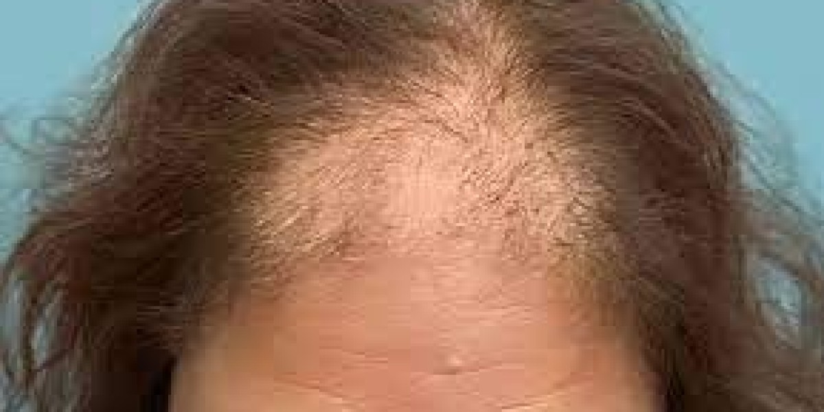 Why Should I Consider Follicular Unit Extraction for Hair Restoration?
