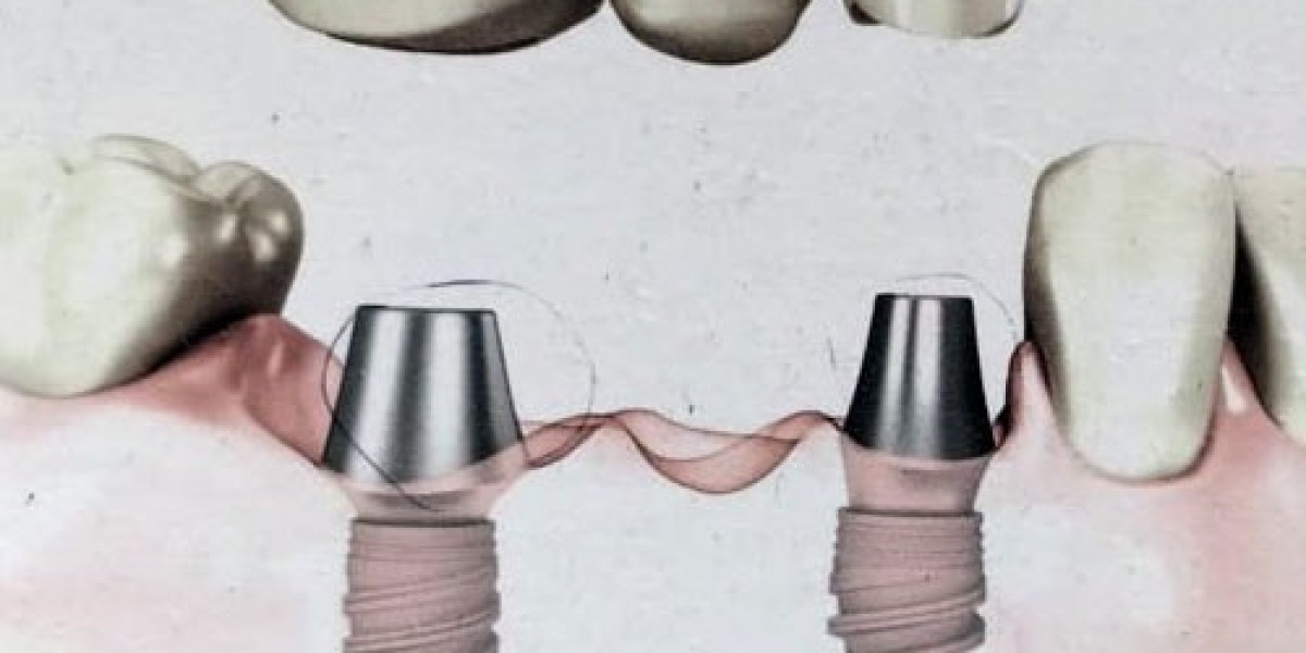 Dental implant cost in Delhi