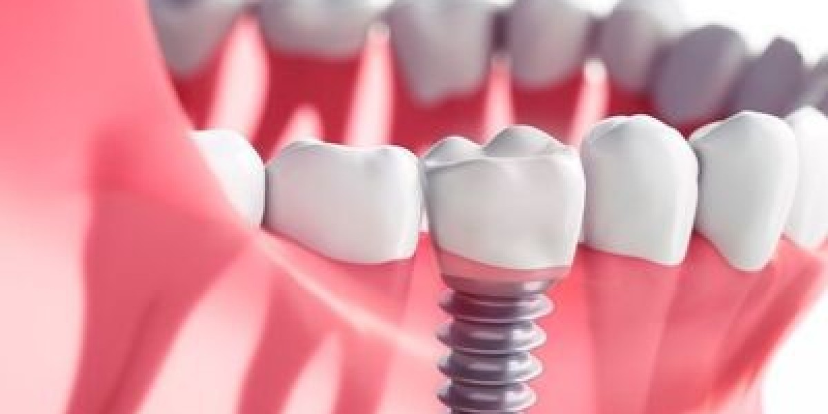 Leading Dental Implants Clinic in Bhubaneswar, Odisha - ABCD Clinic