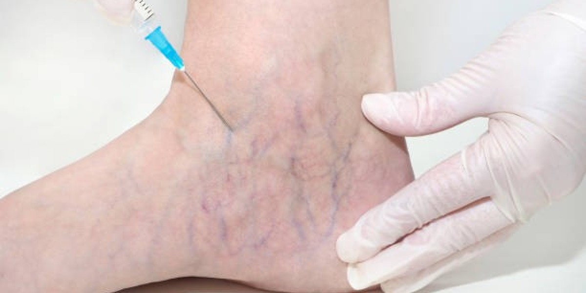 Varicose Veins Treatment Without Surgery