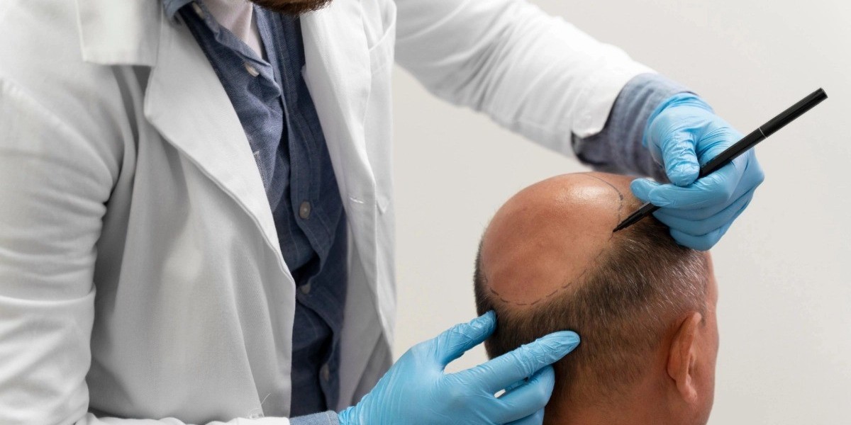 "Explore Turkish Hair Transplant Excellence in Dubai"