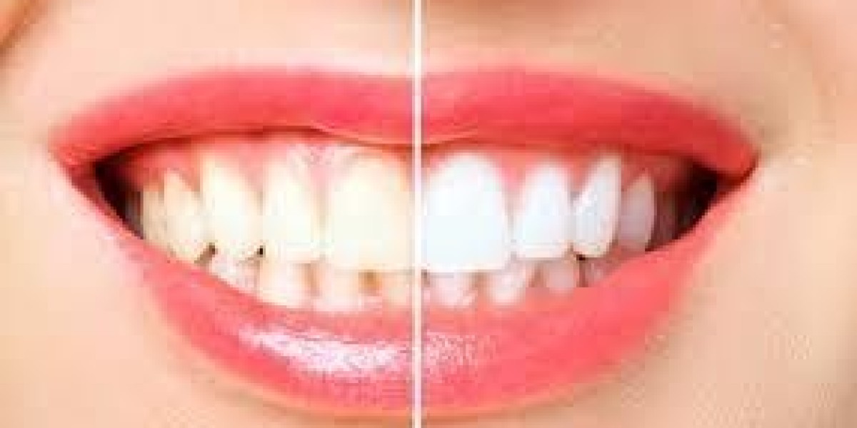 Top Tips for Long-Lasting Teeth Whitening Results in Dubai