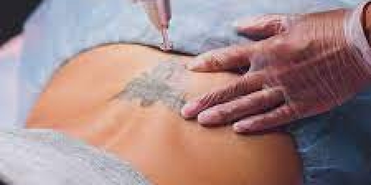 Laser Tattoo Removal Riyadh: Your Guide to Clear Skin