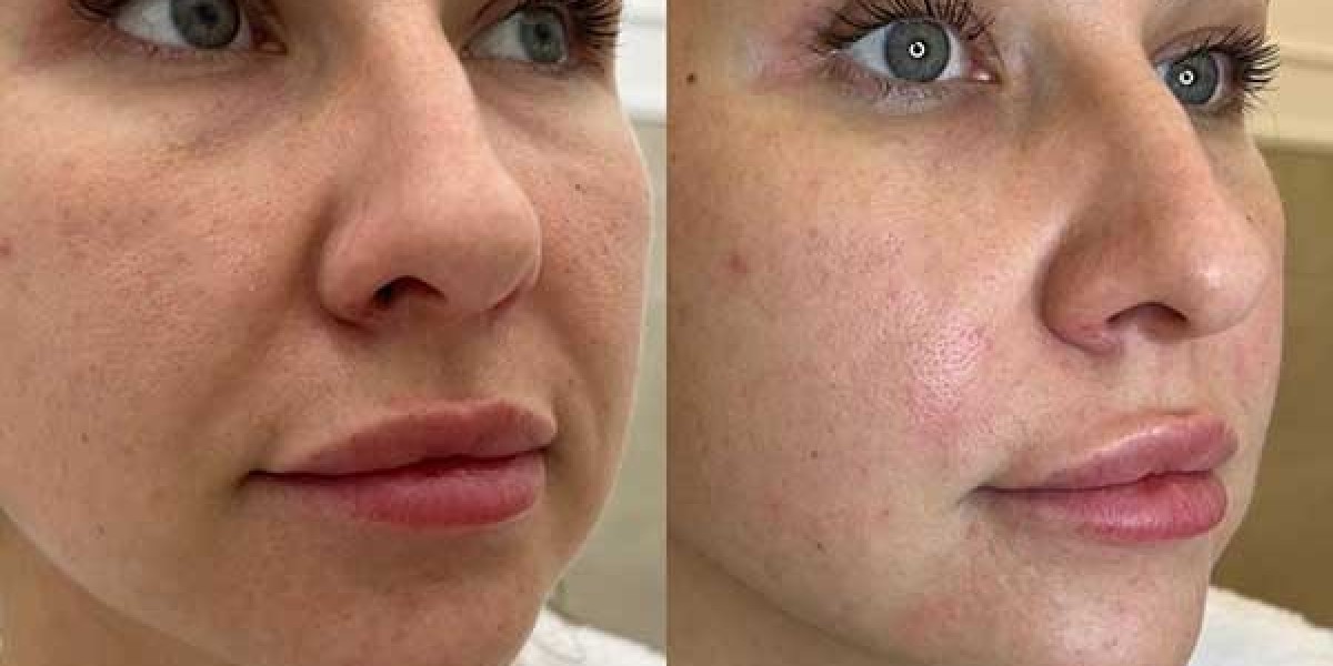 Risks and Side Effects of Thread Lifts: What You Should Know