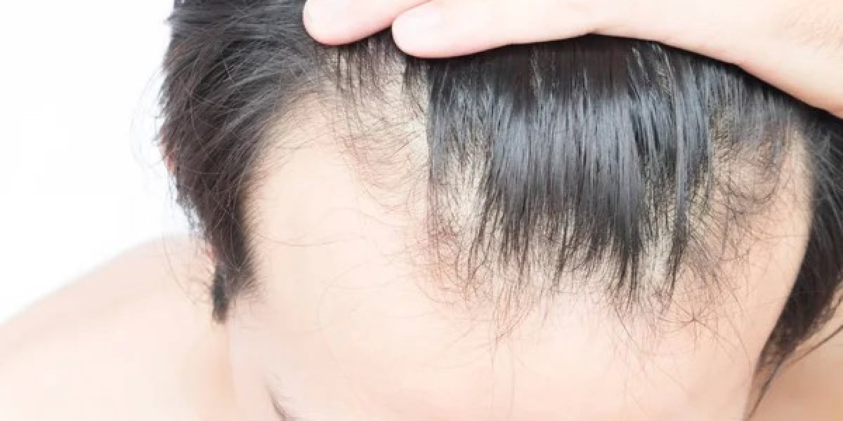 Al Borj Aesthetics discusses e-cigarette use before and after hair transplants