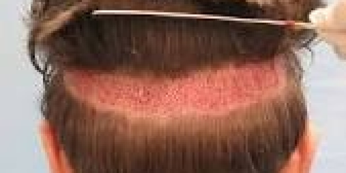 Is FUE Hair Surgery Suitable for Both Men and Women?