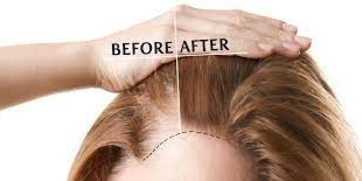 Best Hair Surgery Top in Dubai