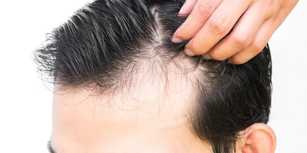 How Can You Tell If You're an Ideal Candidate for Hair Restoration?