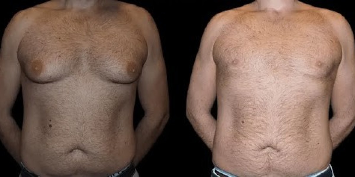 Tips for Managing Expectations Before Male Breast Reduction Surgery in Dubai