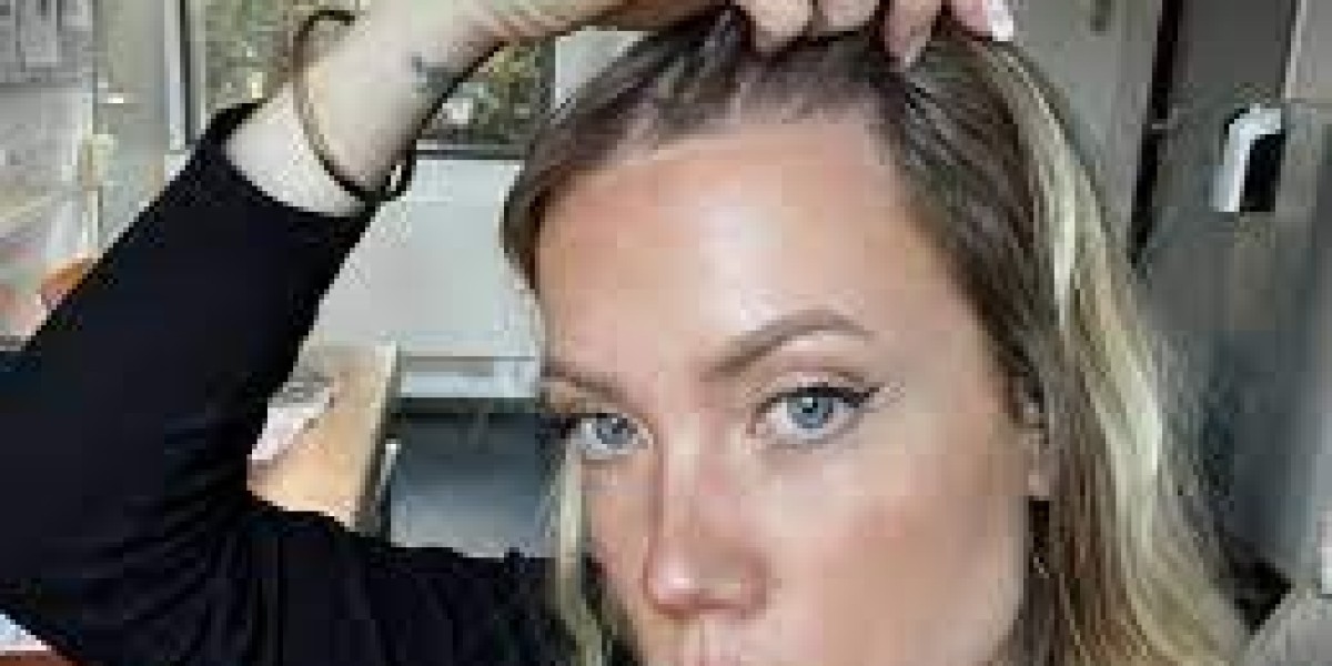 How Long Does FUE Hair Surgery Take to Heal?