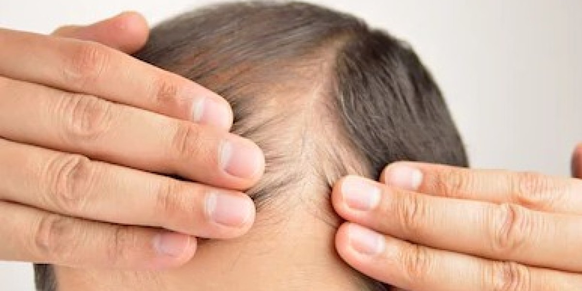 Finasteride and Lifestyle Changes: Enhancing Hair Growth in Dubai
