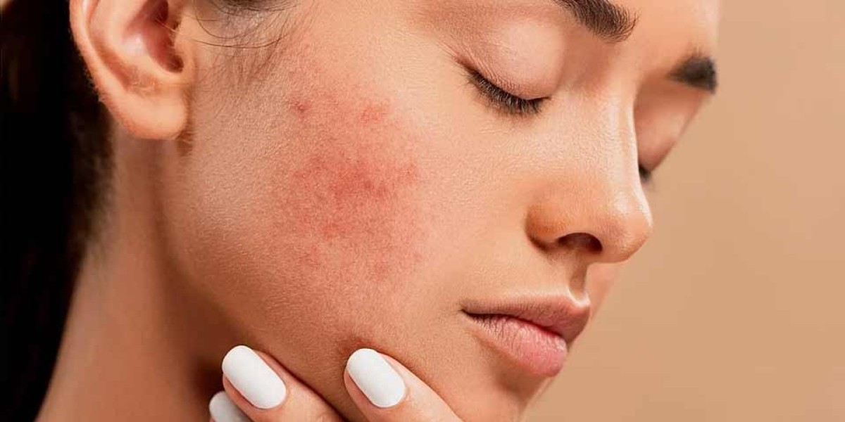 7 Myths About Pimples Treatment in Dubai