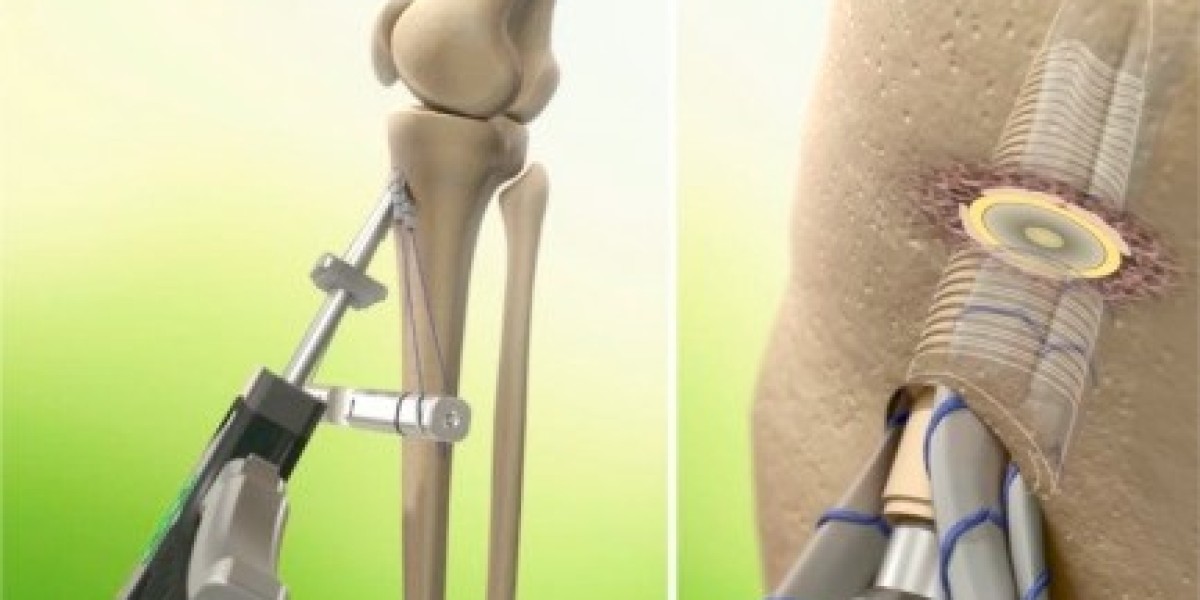 Orthopedic Soft Tissue Repair Market Share, Key Drivers, Trends, Challenges and Competitive Analysis Report 2032