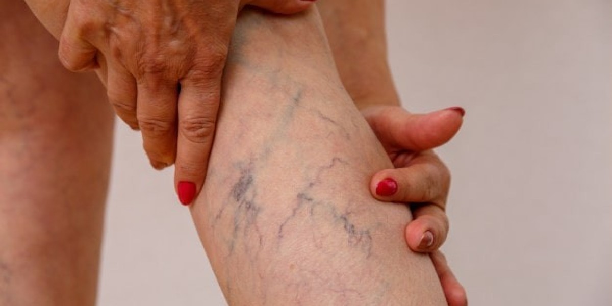Varicose Veins Treatment: Discover Safe and Effective Methods