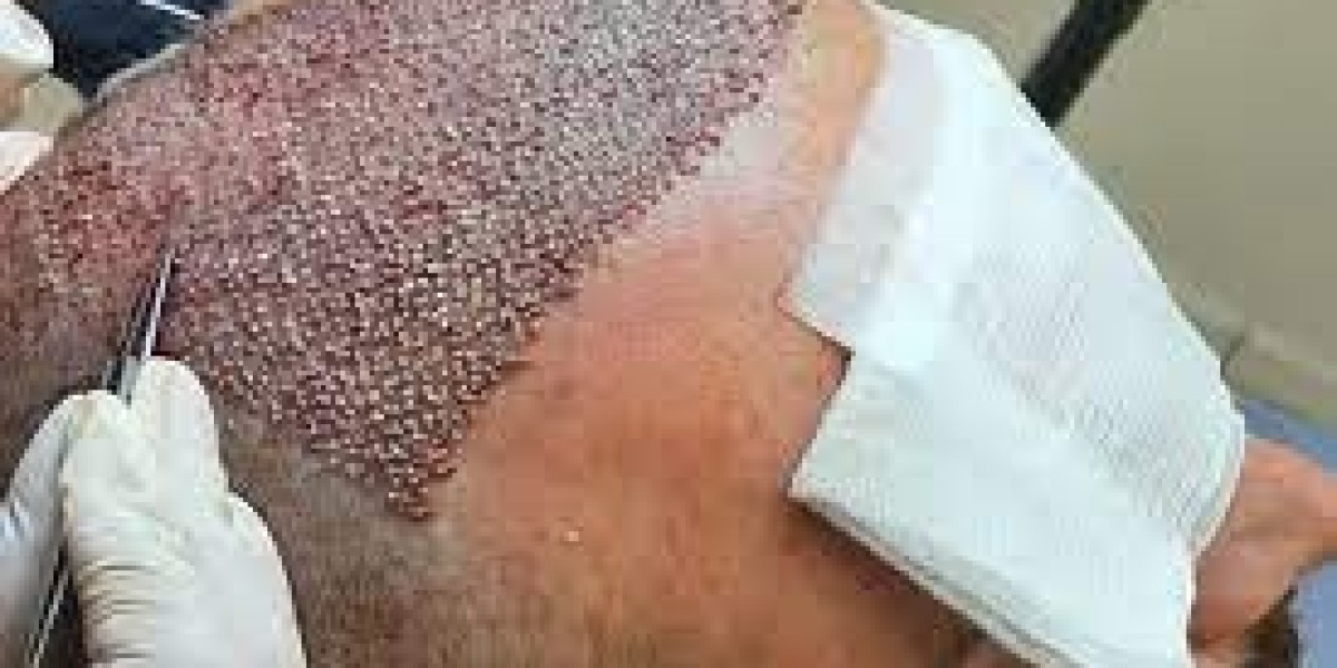 Step-by-Step Hair Surgery Patient Care