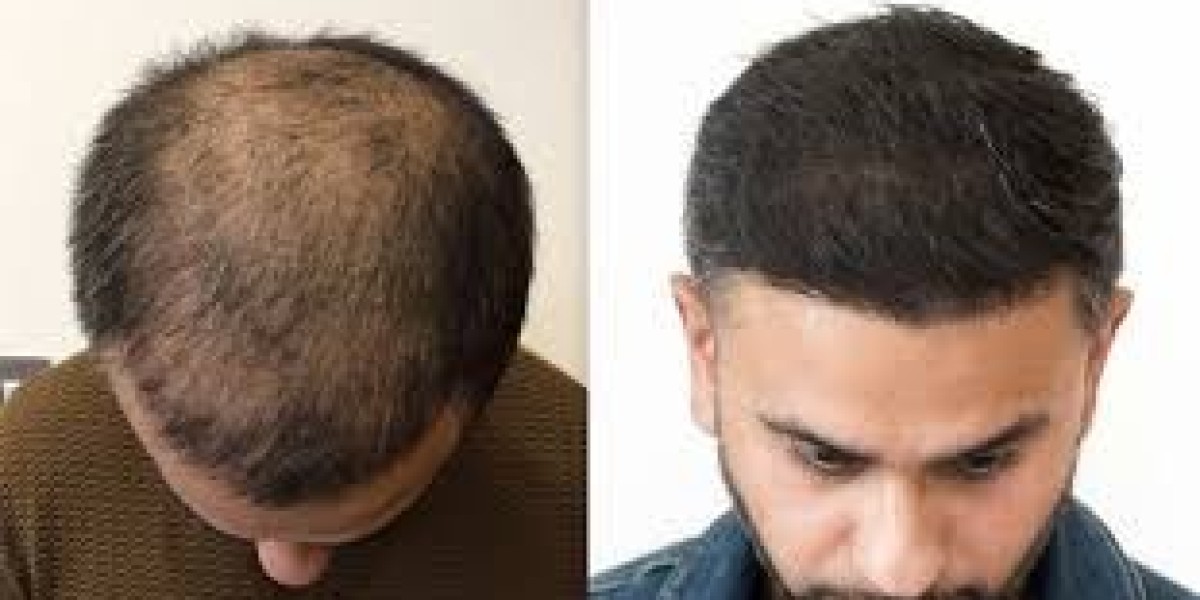 After a hair transplant, how many days of rest are required?