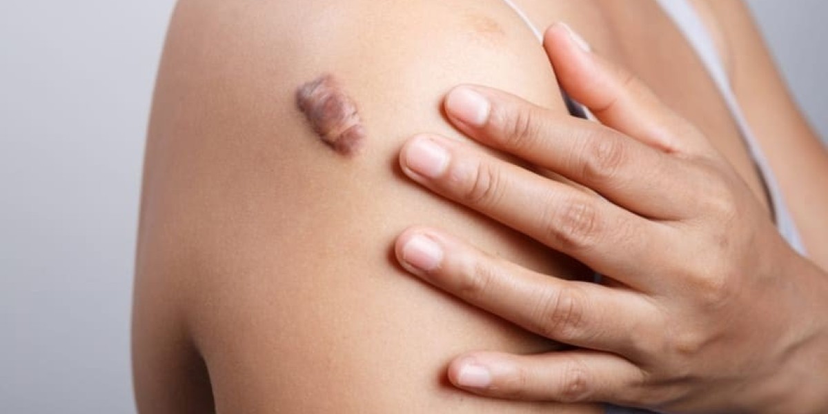 Keloid Treatment for Different Skin Types <br>Myths and Facts About Keloid Treatment