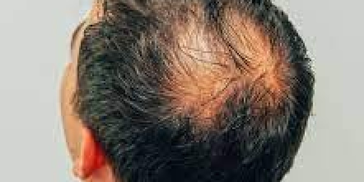 Finasteride for Women in Dubai: Is It Safe?