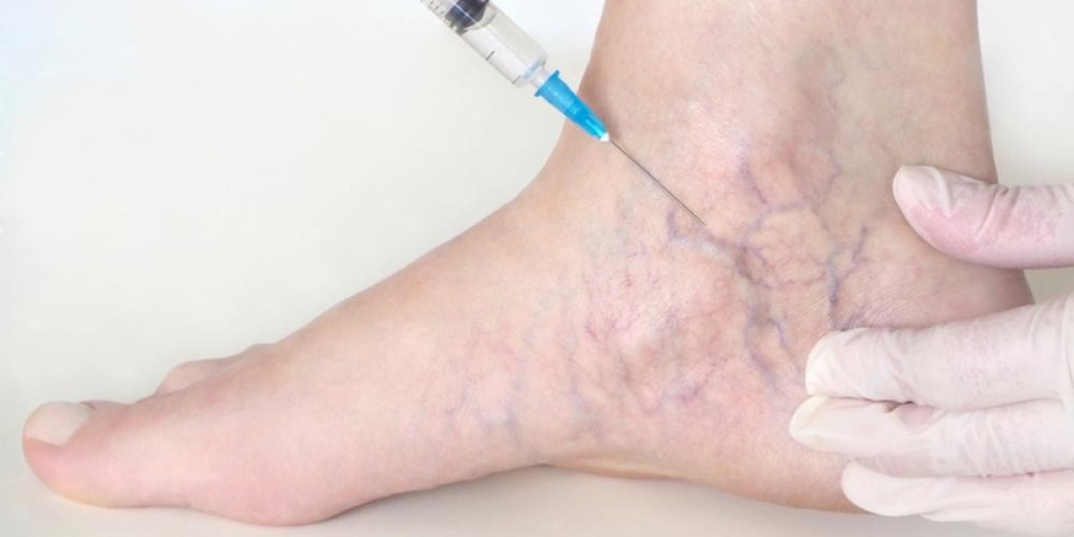 "Fast-Track Varicose Veins Treatment: Getting Results Quickly"