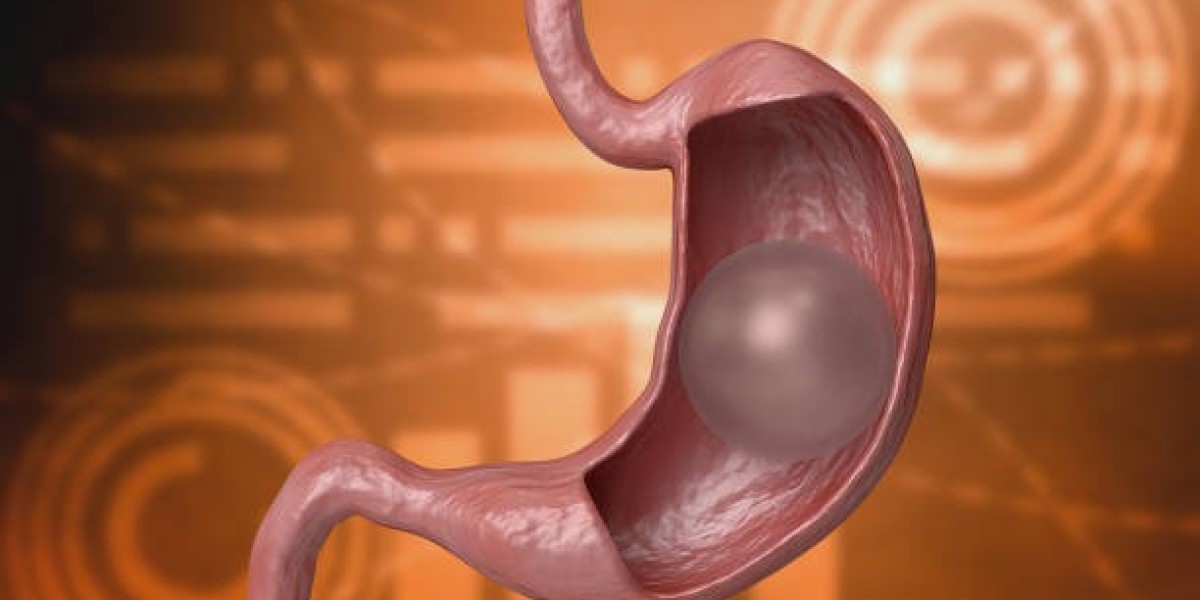 Inside Look: Gastric Balloon Surgery Recovery