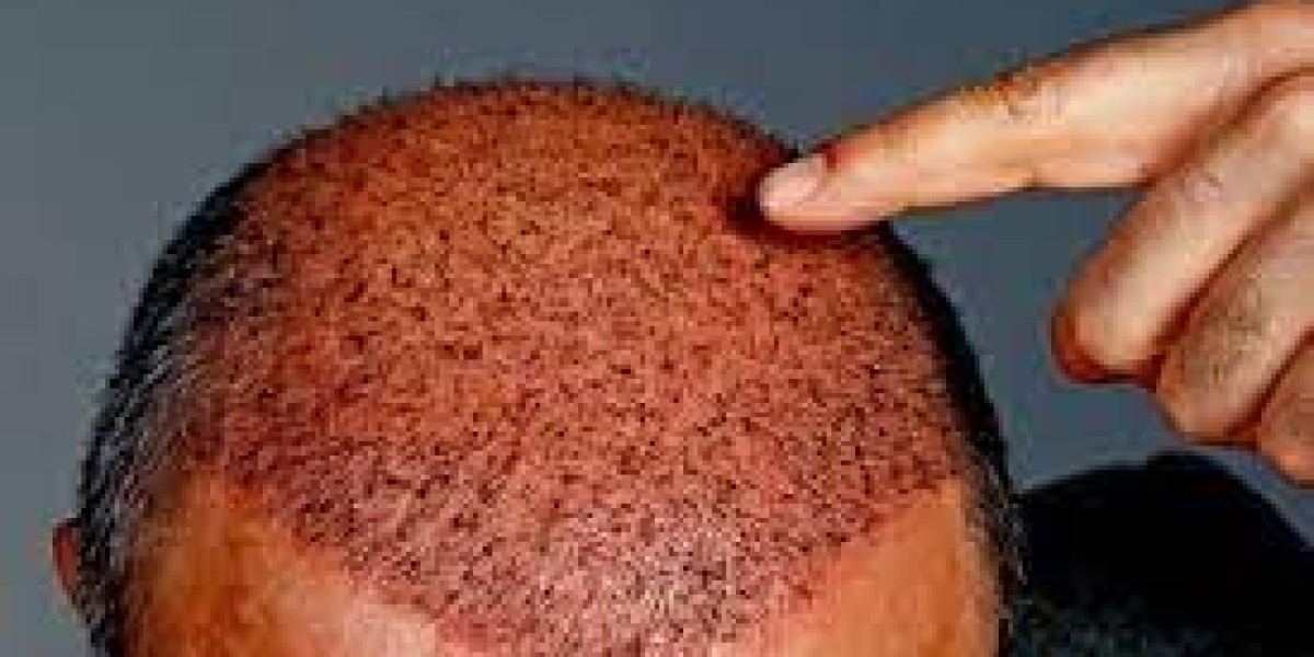 Consider When Choosing Hair Transplant: UAE vs Turkey