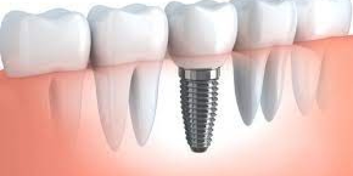 The Price of Teeth Implants: A Comprehensive Guide