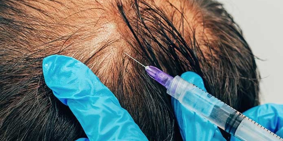 Understanding the Process of Hair Fillers in Dubai