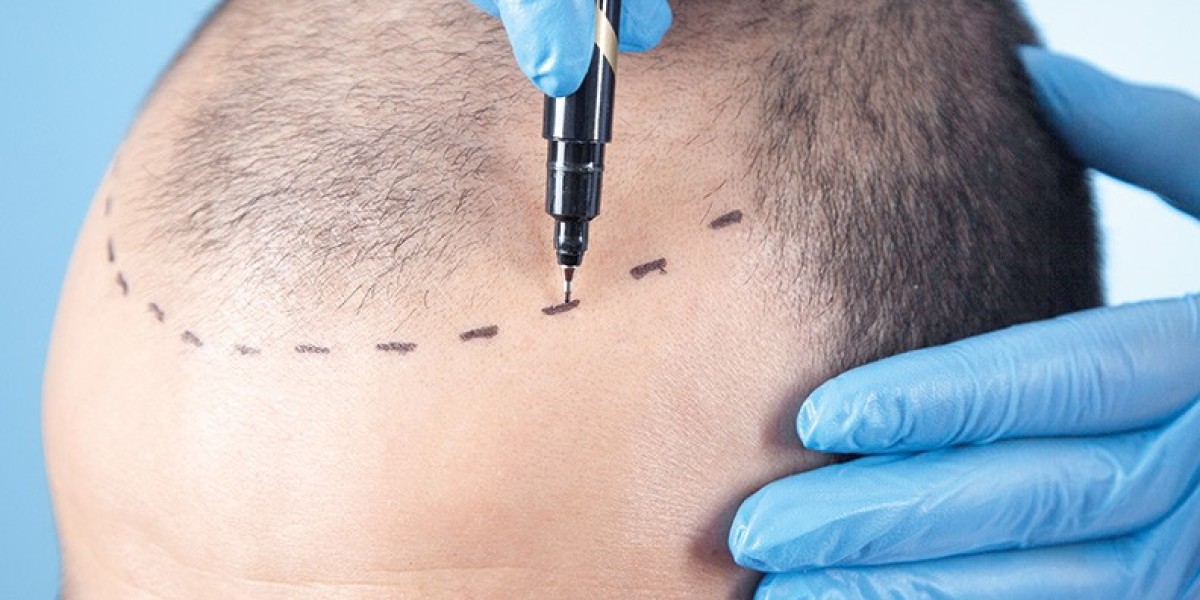 Your Complete Guide to Turkish Hair Transplants in Dubai: Costs, Benefits, and Results