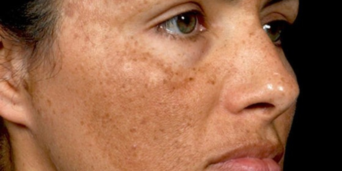 Natural Remedies for Melasma: Gentle Ways to Restore Skin Radiance