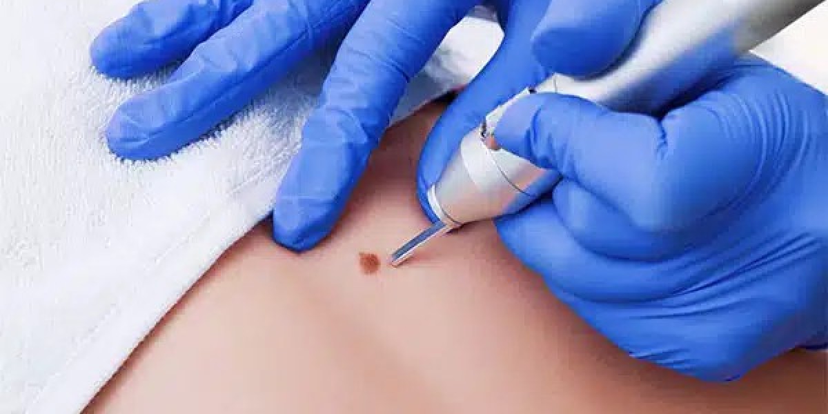 Skin Lesion Removal | Diagnosis & Treatment