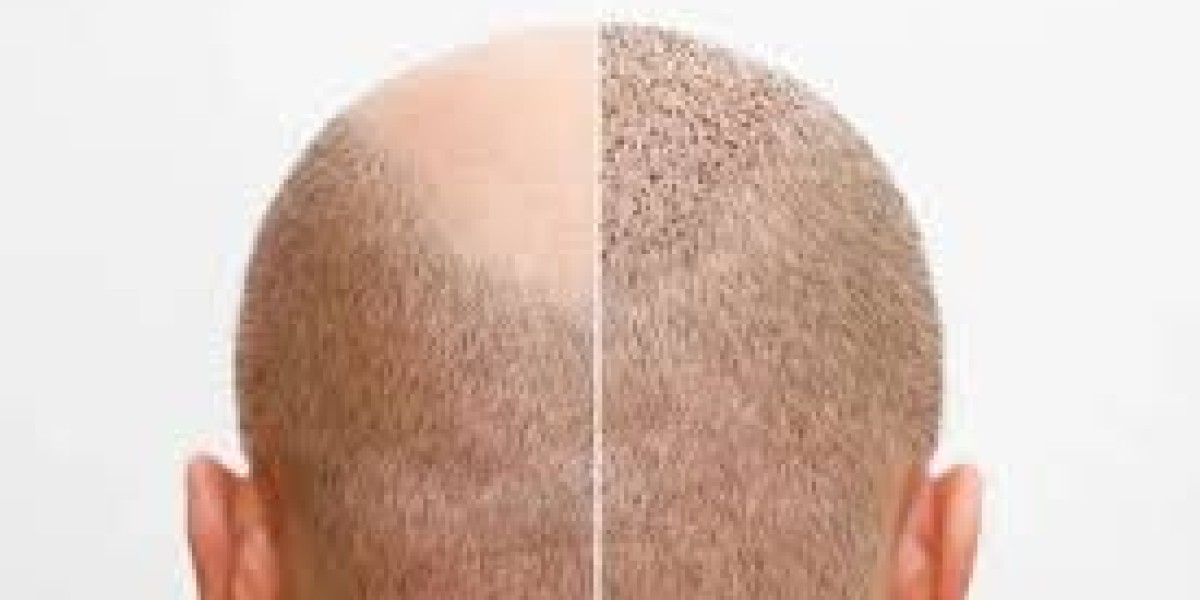 زراعة الشعر في دبي: تفصيل الأسعار (لكل طعم والمزيد!)