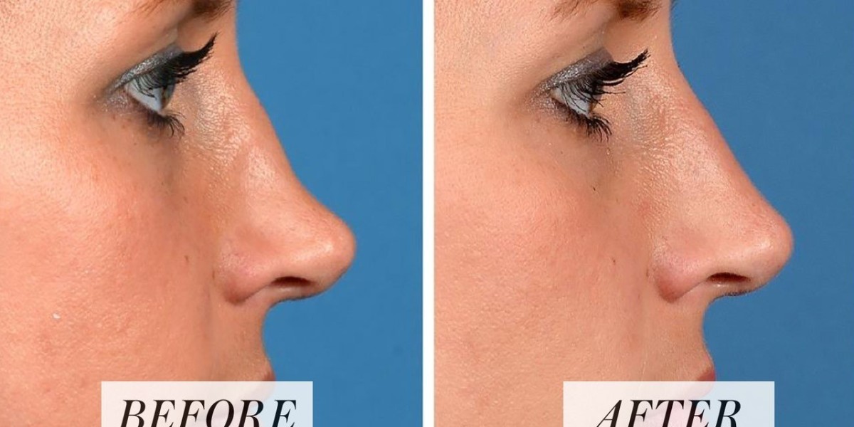 الابتكارات في تجميل الأنف السائل: ما الجديد في المشهد الجمالي في دبي