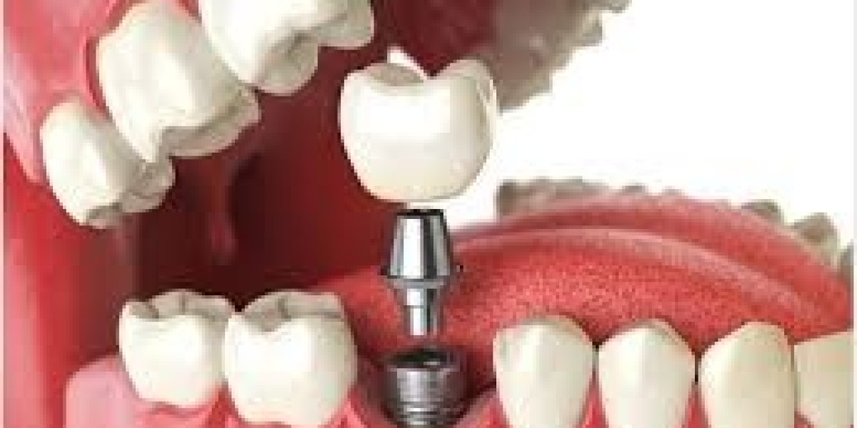 The Latest Technologies in Dental Implants Available in Islamabad