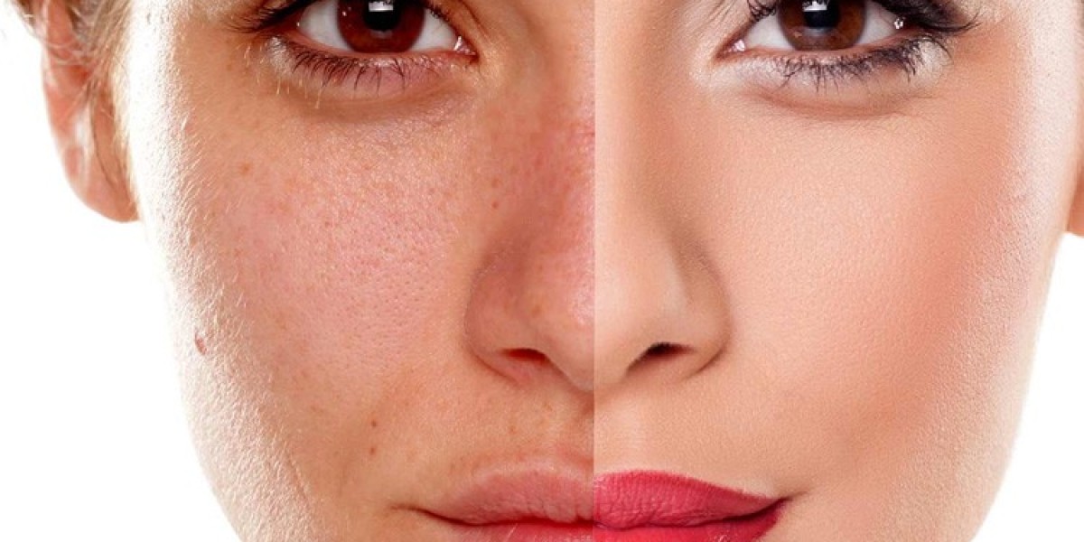 What Are the Best Pigmentation Treatments in Dubai?