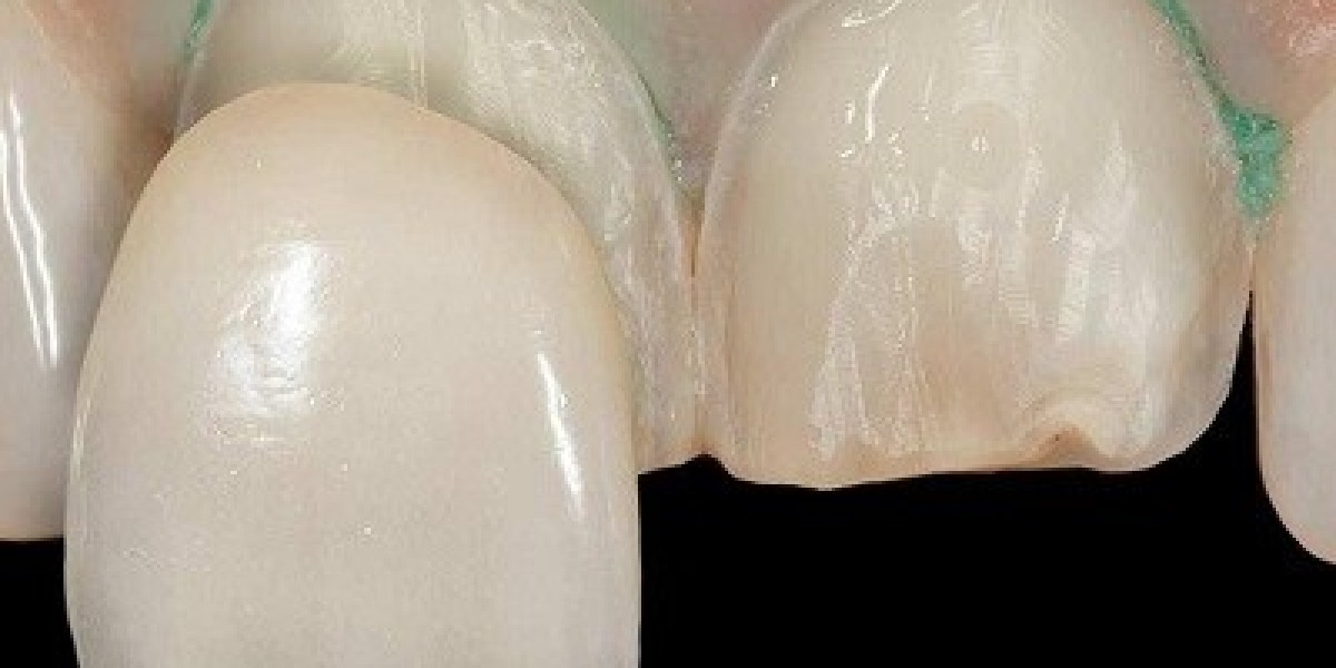 E-max Veneers in Dubai: From Consultation to Completion