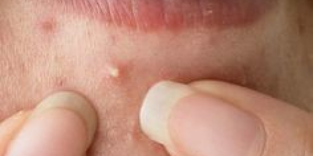 How Incision and Drainage of Abscesses in Riyadh Can Improve Your Health