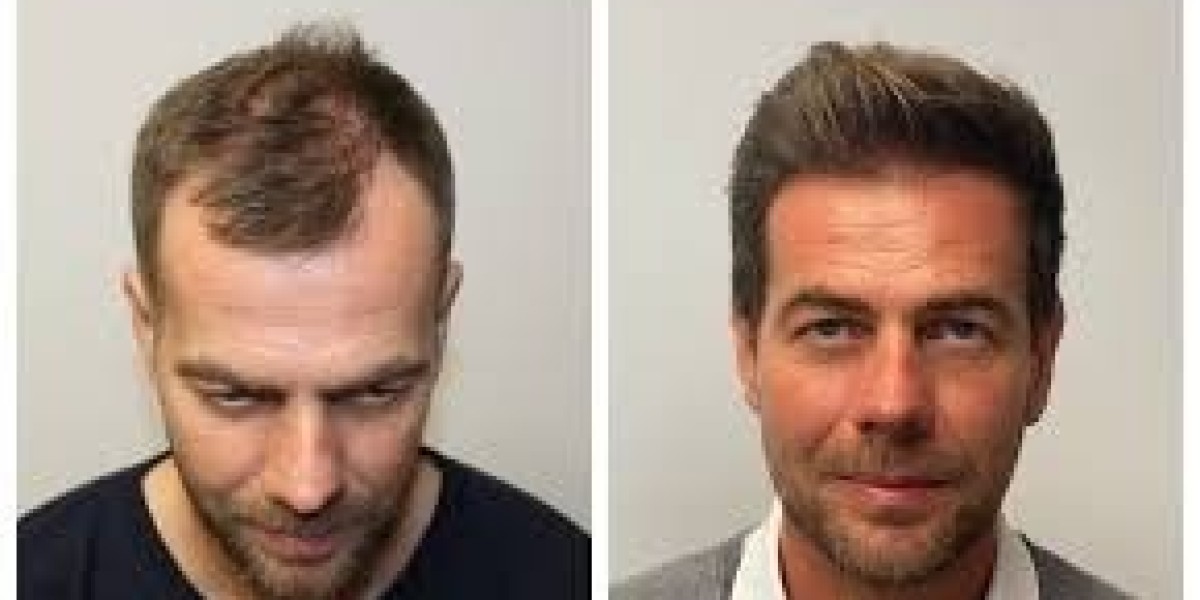 "زراعة الشعر للمشاهير في دبي: من يحصل عليها؟"