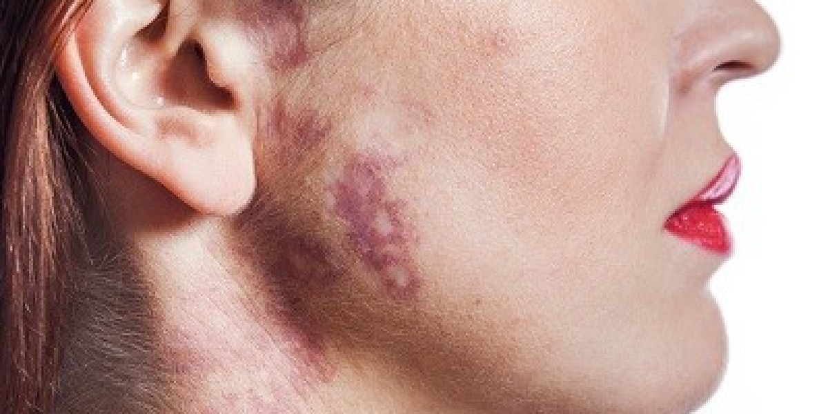 Surgical Removal of Birthmarks: What You Need to Know