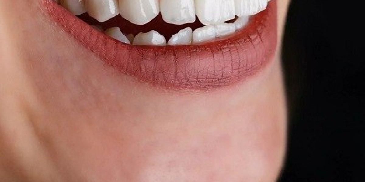 E-max Veneers: The Science Behind the Perfect Smile in Dubai