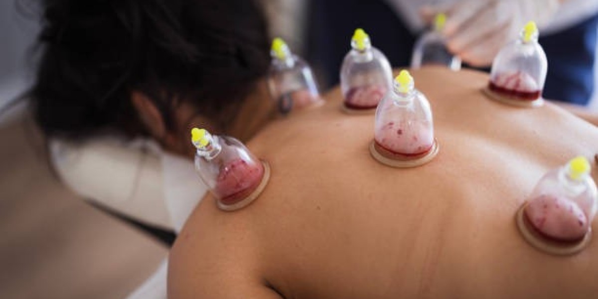 Cupping Treatment in Riyadh: The Secret to Enhanced Vitality