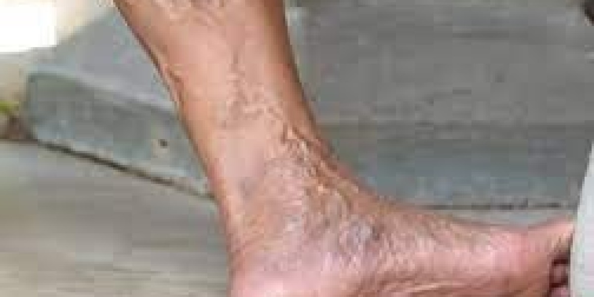 Everything You Need to Know About Varicose Veins Treatments in Riyadh