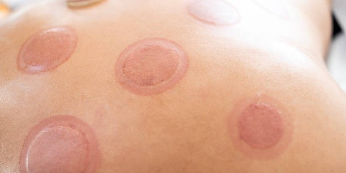 The Benefits of Cupping Treatment in Riyadh for Stress Relief