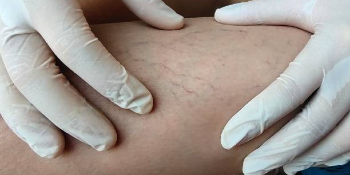 Real Results: Success Stories from Vascular Surgery in Riyadh